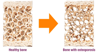 When osteoporosis occurs, more bone is being removed than added leading to a reduction in bone density